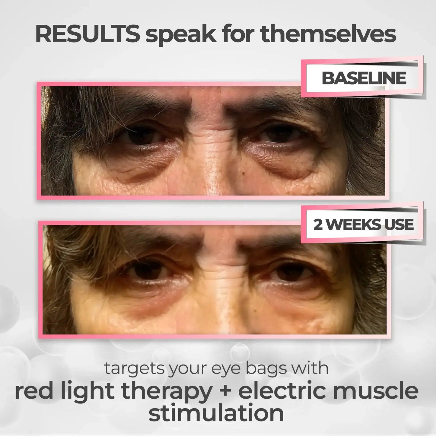 Look More Rested in Minutes with AuraLift™ — 2-in-1 Red Light + EMS Eye System