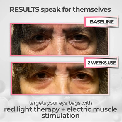 Look More Rested in Minutes with AuraLift™ — 2-in-1 Red Light + EMS Eye System