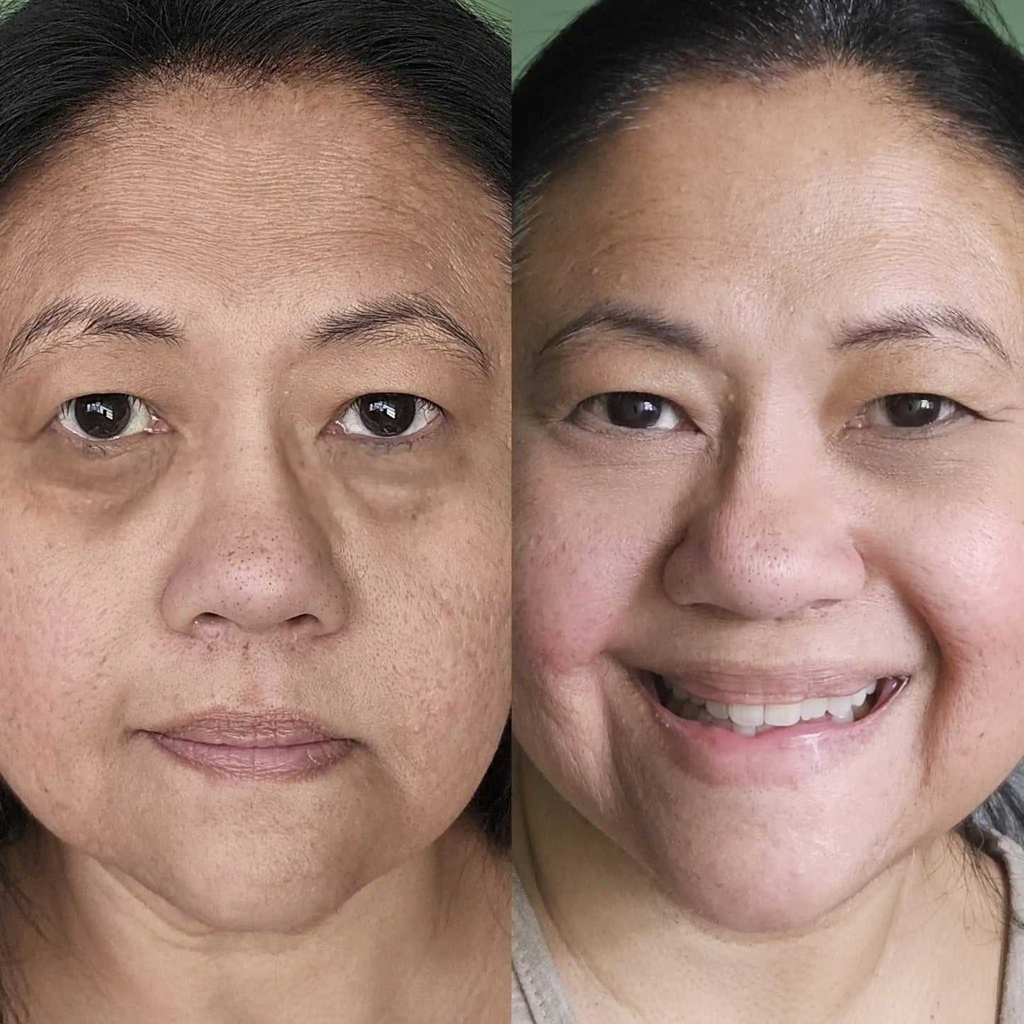 Look More Rested in Minutes with AuraLift™ — 2-in-1 Red Light + EMS Eye System